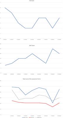 Intranasal esketamine as therapeutic option: a case report of an adolescent with treatment resistant depression